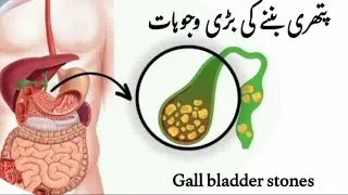 How  stones are formed in  Gall bladder|   Gall bladder stones ki wajuhat in urdu/Hindi