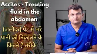 Ascites - Treating fluid in the abdomen (जलोदर) पेट मे भरे पानी को निकालने के कितने है तरीके