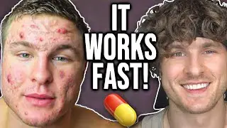 Taking THESE Vitamins Eliminates Acne!