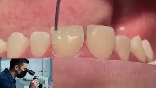 What Expect!😮Professional Teeth Cleaning A Dentist's Step-by-Step #001