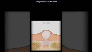 Ganglion Cyst Of The Wrist - #shorts