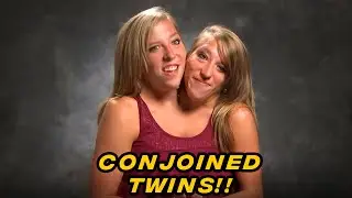 ALL YOU NEED TO KNOW About TLC Conjoined Twins Abby & Brittany