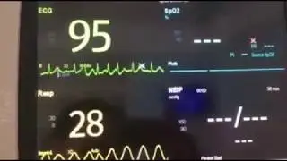 Brady-Tachy syndrome in Sinus sick syndrome