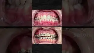 Результат исправления прикуса за 13 месяцев #braces #брекеты #orthodontia