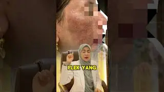 Flek hitam pekat bisa memudar?! Mitos atau nyata?🤷&zwj;♀️