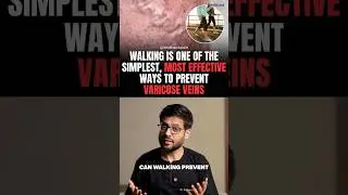 Can walking prevent varicose veins?