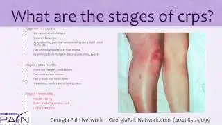 RSD & CRPS Treatment at Top Georgia Pain Management Clinics