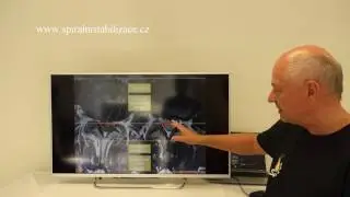Výhřez meziobratlového disku