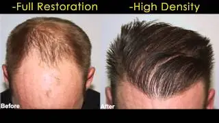 Hair Restoration Result by Dr. Baubac Hayatdavoudi of Alvi Armani