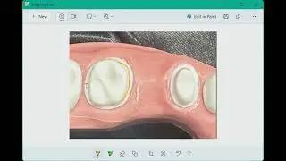 Perfecting Margin Widths for Premolar and Molar Crowns | ADEX Crown Prep Tips