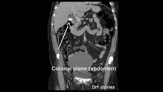 Basic knowledge in ct scan #drt  #paramedicaleducation #radiographer_course #gallbladderstone