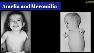 Amelia limb abnormality (Deformity) Birth defect  / Phocomelia ;  Absence of the limb