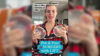 Моя подтяжка груди с заменой импланта на гораздо меньший размер #якорнаяподтяжка #операцияпоувели...