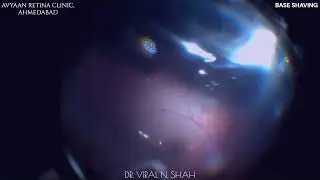 Retinal Detachment in Giant Retinal Tear