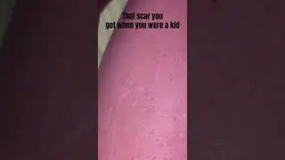 that scar you got when you were a kid
