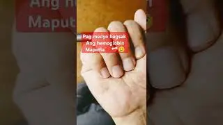 Bagsak ang hemoglobin😢😢#shortviral ##dialysisjourney