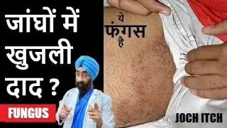 JOCK ITCH Simplified Cure - जांघों के बीच दाद-खुजली | FUNGAL GROIN Infection | Dr.Education