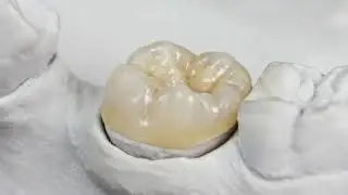 What are Dental Crowns made of? | Kobza Dental