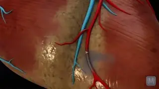 What Is A Heart Attack? | Match Health