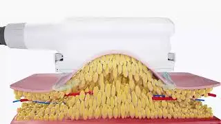 Freeze Fat Without Surgery | Medixora CoolTrim Fat Freezing Machine