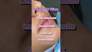 Unveiling The Ultimate Beauty Benefits Of Fillers At Delooks Clinic