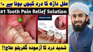 Aqal Darh nikalna zaroori hai? | Wisdom tooth pain home remedy |Aqal Darh ke Dard Ka Ilaj|Desi Ilaj