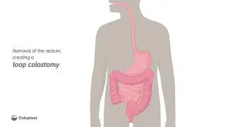 Creation of a loop colostomy by removing the rectum | Ostomy surgery | Coloplast India