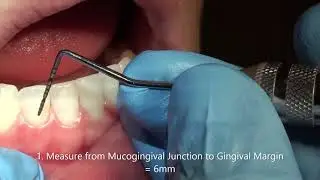 Minimal Attached Gingiva MAG