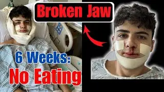 I Broke My Jaw | No Food + Surgery