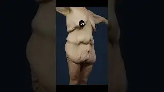 Extreme Bikini Body Lift Transformation in 60 Seconds #plasticsurgery #beforeandafter #shorts