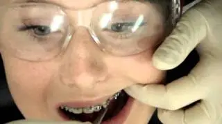 Upper & Lower Archwire Change West London Orthodontist
