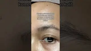 BREAKOUT SKIN #beforeandafter #bruntusan #kusam #kulitkusam #skincare  #skincareroutine