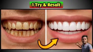 White Teeth in one Trick 😬 एक ही बार में दांत चमकाए ✨✨✨ Healthy Trip #helth #teeth #deemeevlogs