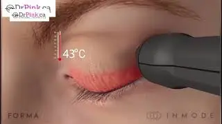 Forma RF Treatment for Dry Eye