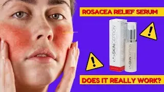 Rosacea Relief Serum Review | DOES IT REALLY WORK? | Watch Before you Buying it!