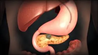 Illustration video of EUS guided pancreatic cyst treatment - Source EBS
