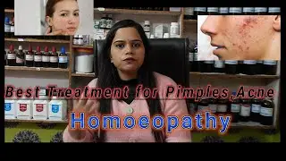 Best homoeopathy treatment for pimples,acne