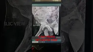OBTURETER AND ILIAC VI8#sorts