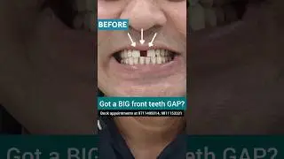 BIG Front Teeth Gap Makeover without Braces; Dr. Srishti Bhatia #smilemakeover