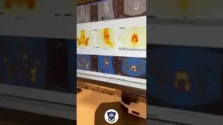 Im&aacute;genes h&iacute;bridas SPECT/TC: precisi&oacute;n diagn&oacute;stica