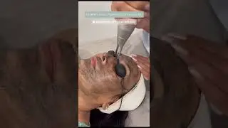NewDerma Carbon Pico Laser Treatment. Advanced Solution for Pigmentation & Skin Brightening.