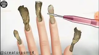 ASMR Ingrown [Fingernail] Removal & [Dead Skin Cells] Treatment Animation [ Satisfying ] #asmr