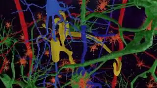 Demyelinating disease. White matter changes.