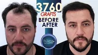 Dr Resul Yaman Hair Clinic - 3760 Grafts Before - After