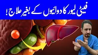 Fatty Liver Symptoms Causes and Treatment Urdu Hindi - Fatty Liver - Irfan Azeem