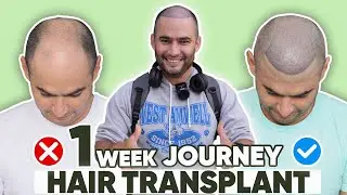 Best Hair Transplant in Cuttack (HX-ZXSD) | Best Results & Cost of Hair Transplant in Cuttack