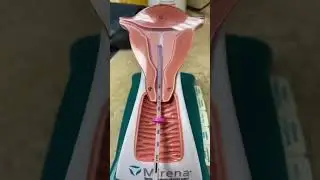IUD insert #iud #iudinsertion #mirena #birthcontrol #obgyn #gynecology