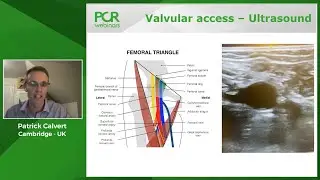 How should I make PFO closure a safe and effective procedure?