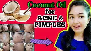 क्या Coconut Oil से Acne,Pimples ठीक किये जा सकते है? How To Use COCONUT OIL To Cure ACNE/PIMPLES|