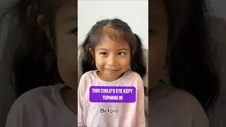 How I treated a young girl with an eye turn called accommodative esotropia. No surgery needed.